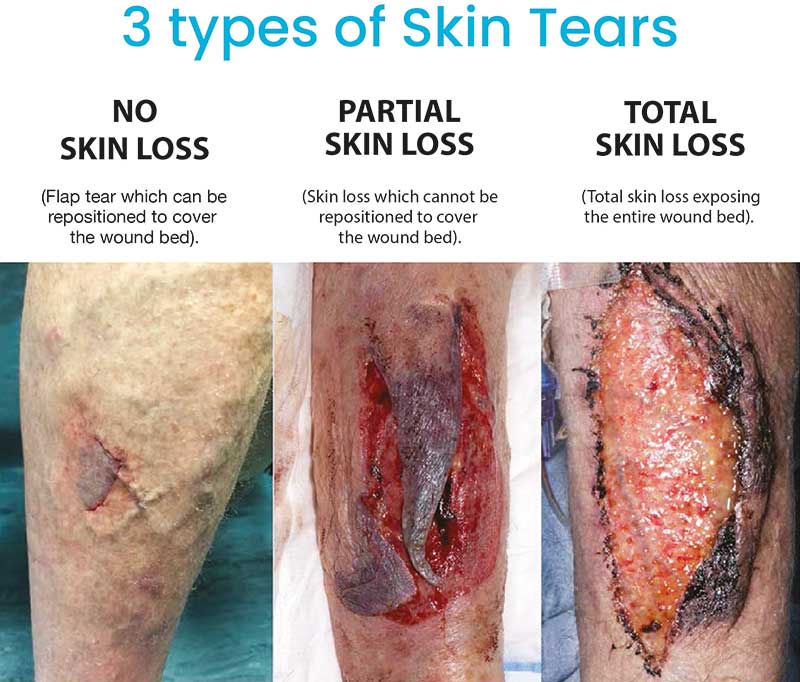 What are skin tears? Identification, Prevention, Care | Richardson  Healthcare