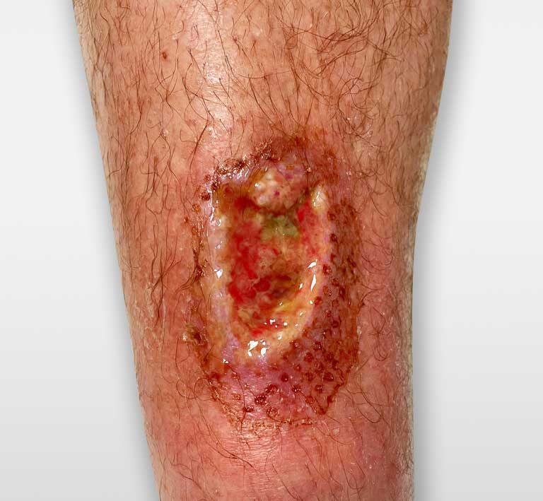 What are the 5 most important steps of skin tear management? | Richardson  Healthcare