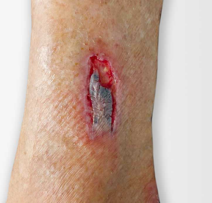 What are skin tears? Identification, Prevention, Care | Richardson  Healthcare