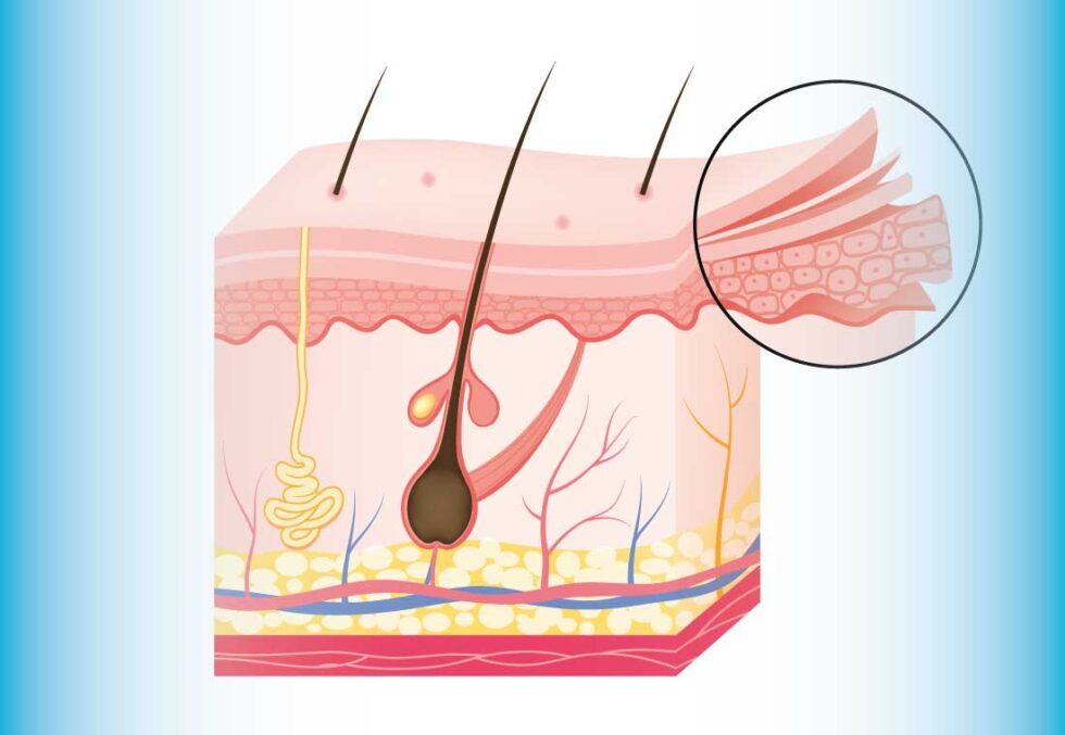 Skin tears richardson healthcare