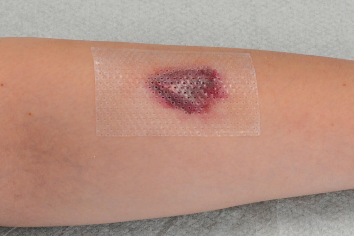 Why Use Silicone Dressings For Better Skin Tear Healing Richardson why-use-silicone-dressings-for-better-skin-tear-healing-richardson