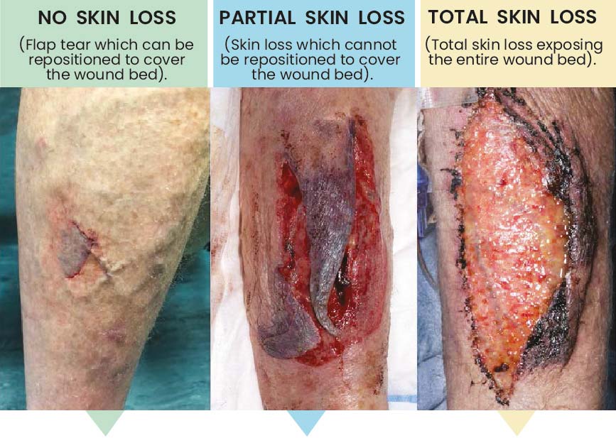 type-of-skin-tears-min Skin Tear Kit Instructions