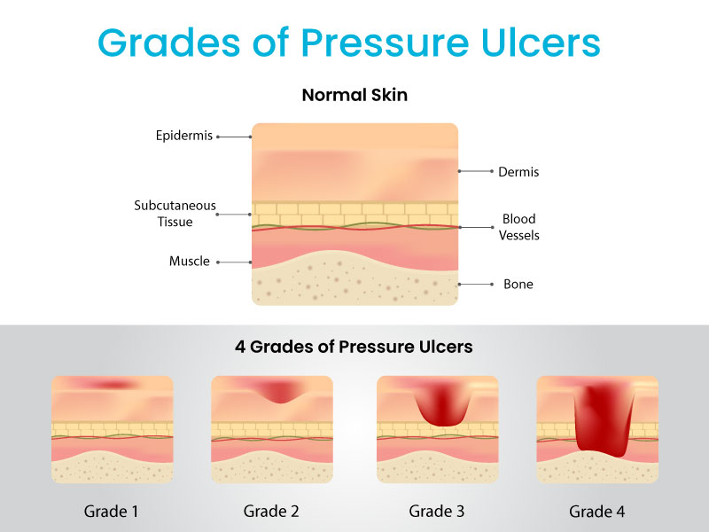 Pressure ulcers (pressure sores) - NHS