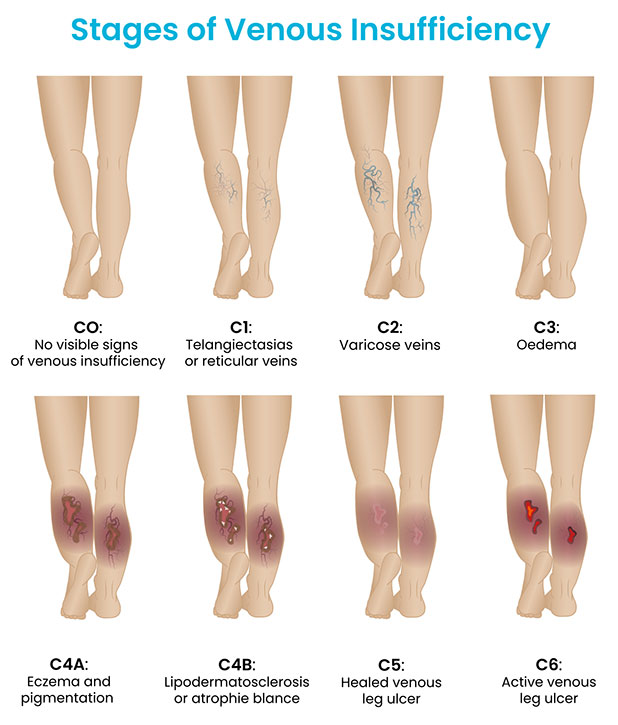 What are the stages of chronic venous insufficiency?