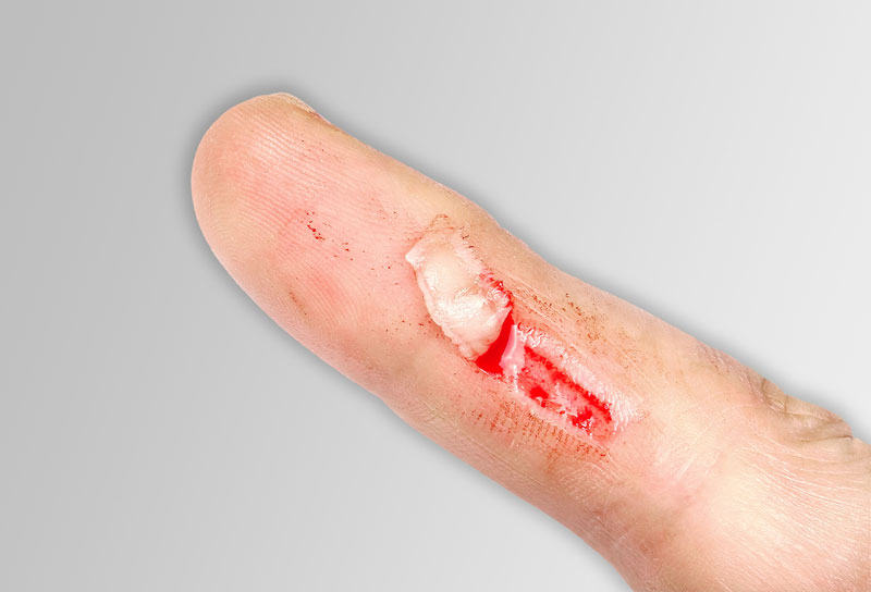 Who is at risk of skin tears? Intrinsic and extrinsic factors | Richardson  Healthcare