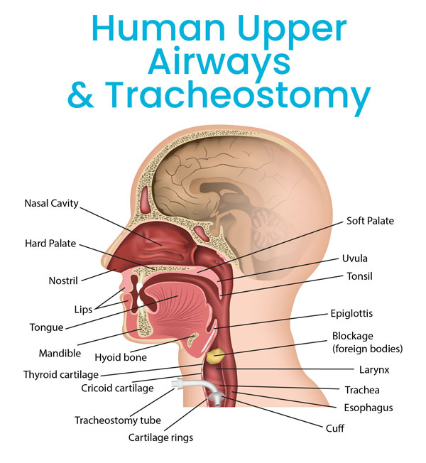 human-upper-air-ways-min What are 10 common reasons for a tracheostomy?